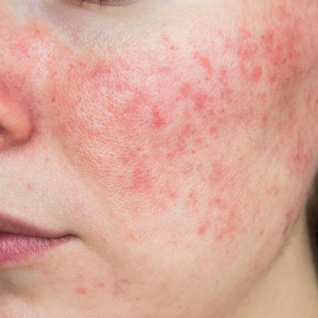 Understanding Rosacea: Triggers and Solutions with Prebiotic Skincare